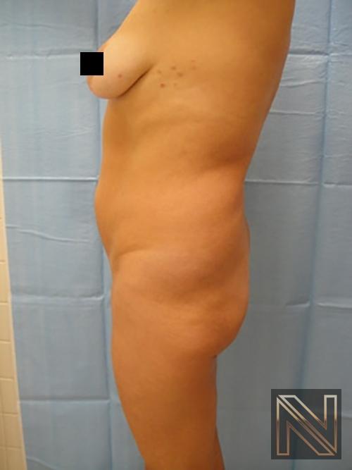 Butt Augmentation: Patient 2 - Before 1