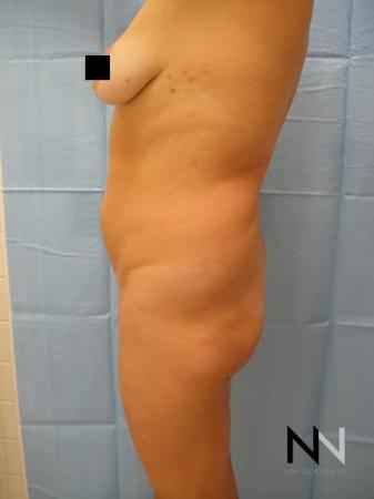 Butt Augmentation: Patient 2 - Before Image 1