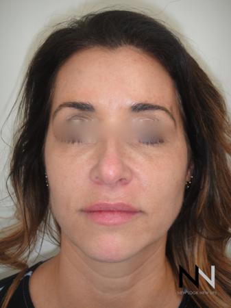Halo™: Patient 3 - After Image 1