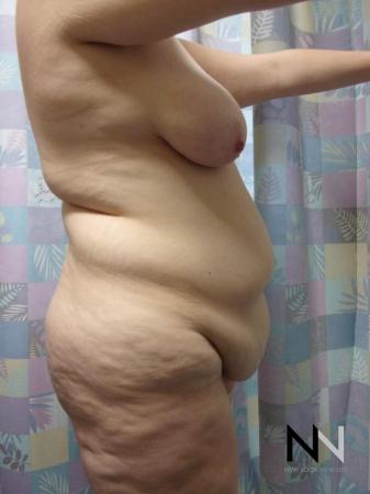 Abdominoplasty: Patient 1 - Before and After Image 3