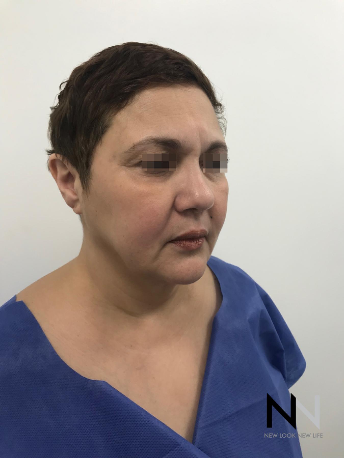 Facelift/Mini Facelift: Patient 1 - Before 