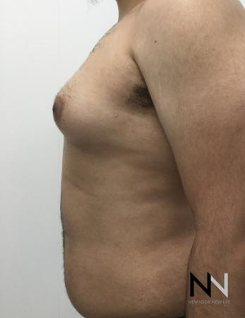 Gynecomastia: Patient 10 - Before Image 2