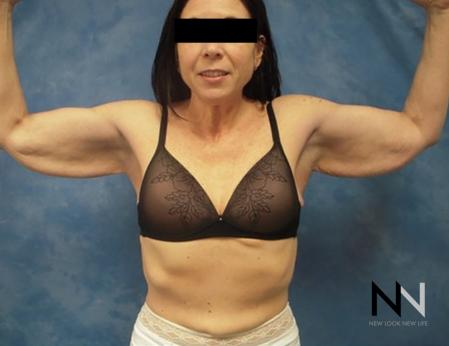 Brachioplasty: Patient 2 - Before Image 1