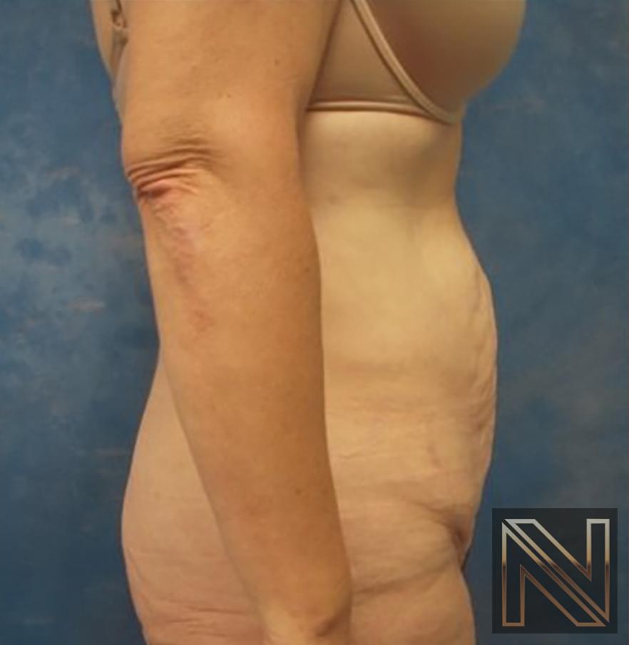 Abdominoplasty: Patient 30 - Before and After 2