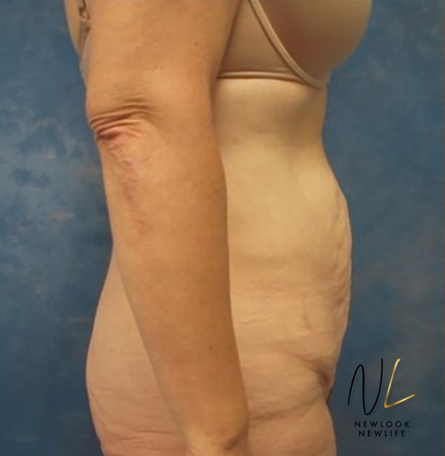 Abdominoplasty: Patient 30 - Before and After 2