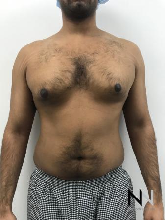 Gynecomastia: Patient 7 - Before Image 1