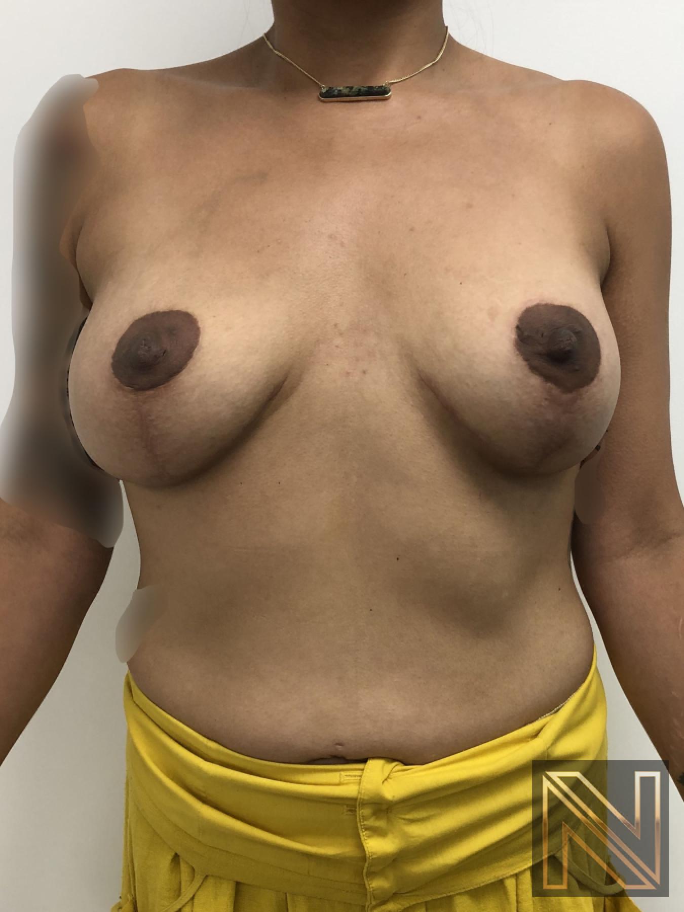 Breast Lift: Patient 1 - After  