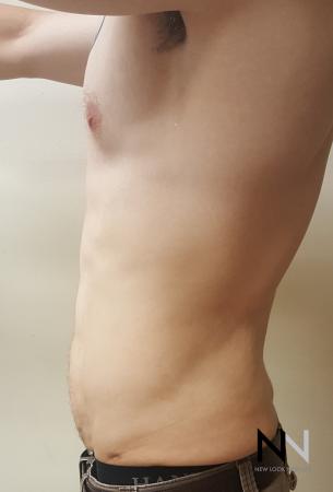Liposuction: Patient 13 - After Image 3
