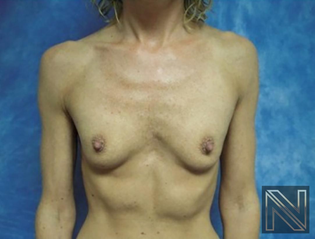 Breast Augmentation: Patient 20 - Before 1