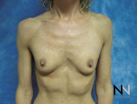 Breast Augmentation: Patient 20 - Before Image 1