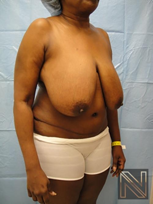 Breast Reduction: Patient 4 - Before 3