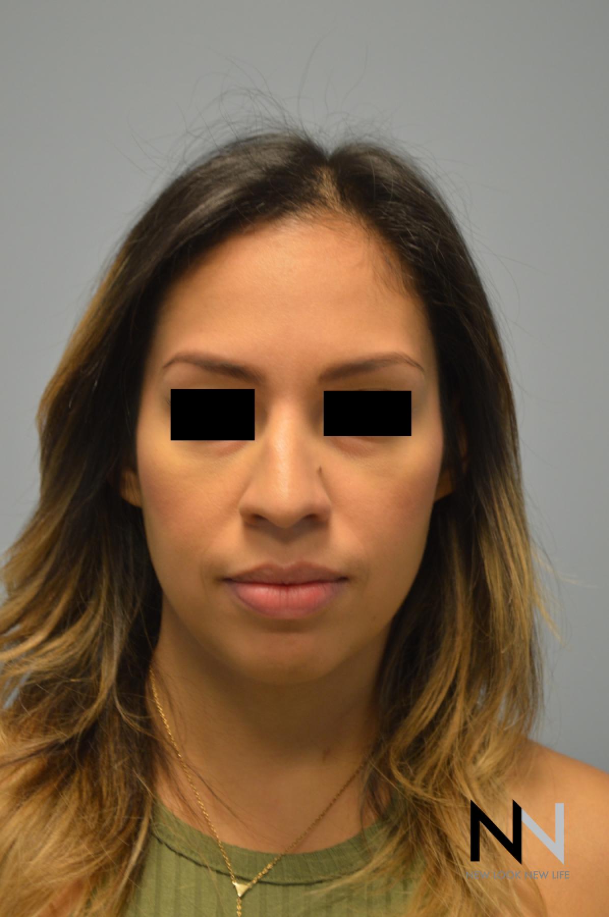 Rhinoplasty: Patient 6 - Before 