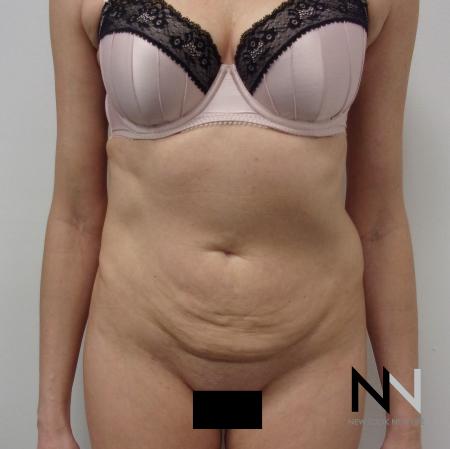 Mini Tummy Tuck: Patient 5 - Before Image 1