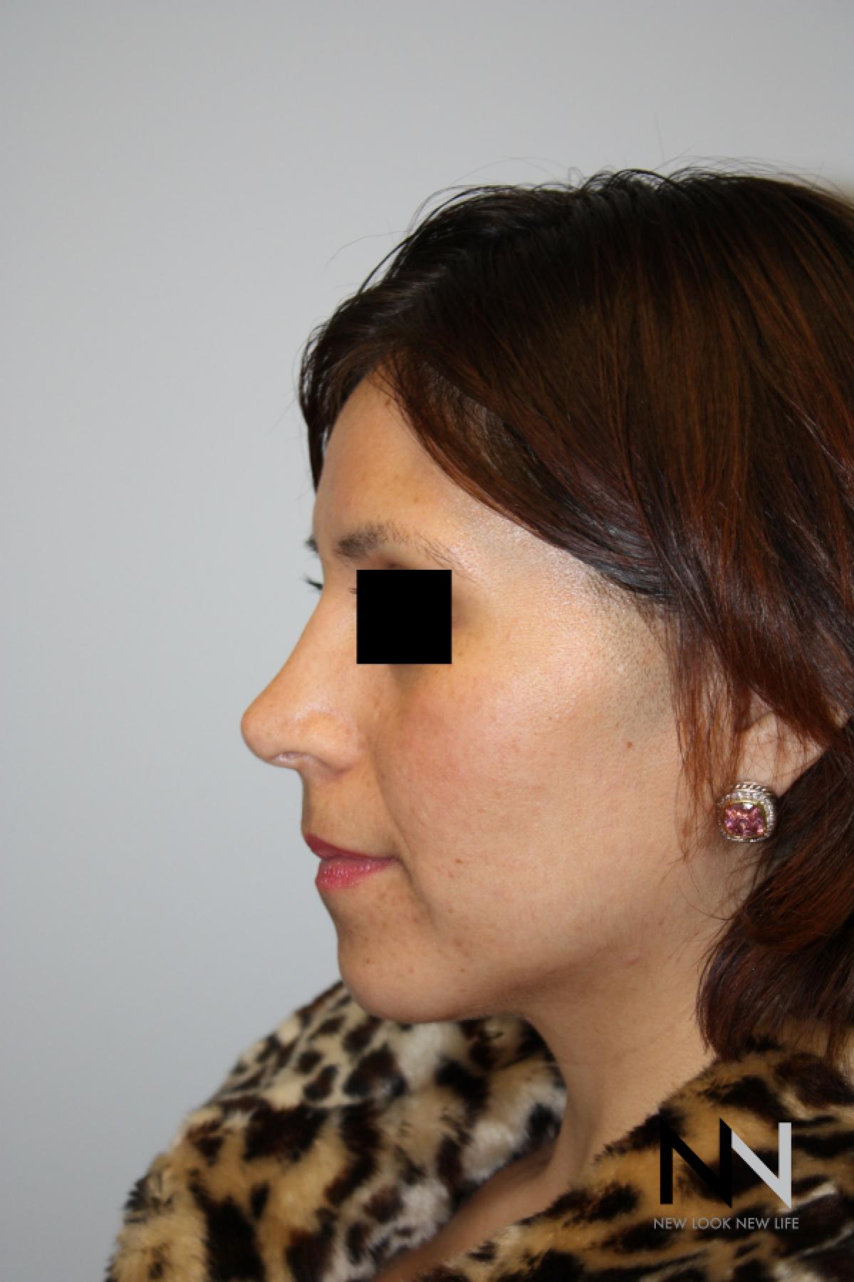 Rhinoplasty: Patient 5 - After 2