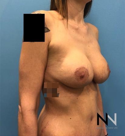 Breast Lift: Patient 18 - After Image 2