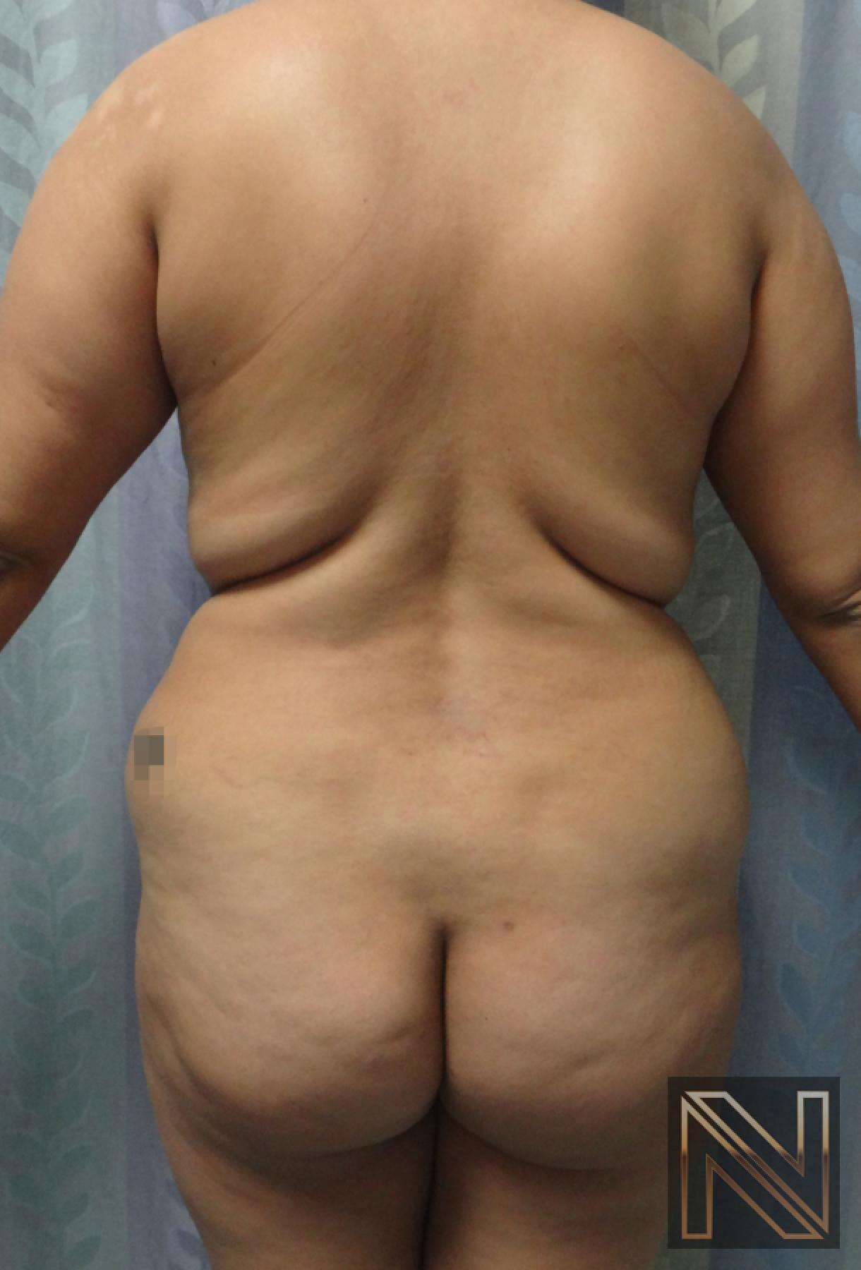 Butt Augmentation: Patient 5 - Before 