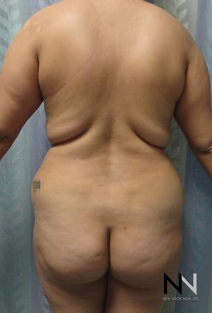 Butt Augmentation: Patient 5 - Before Image 1