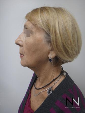Ultherapy®: Patient 2 - After Image 5