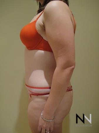 Abdominoplasty: Patient 5 - After Image 2