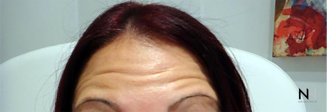 BOTOX® Cosmetic: Patient 5 - Before 