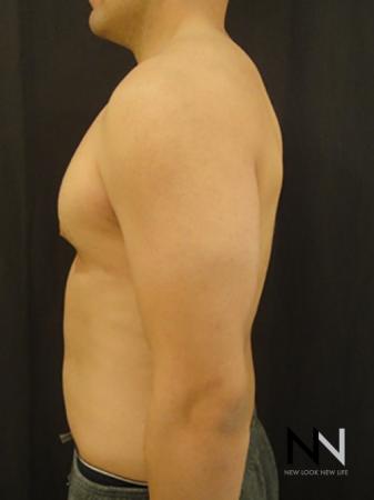 Gynecomastia: Patient 3 - After Image 4