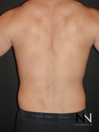 Liposuction: Patient 20 - Before Image 1