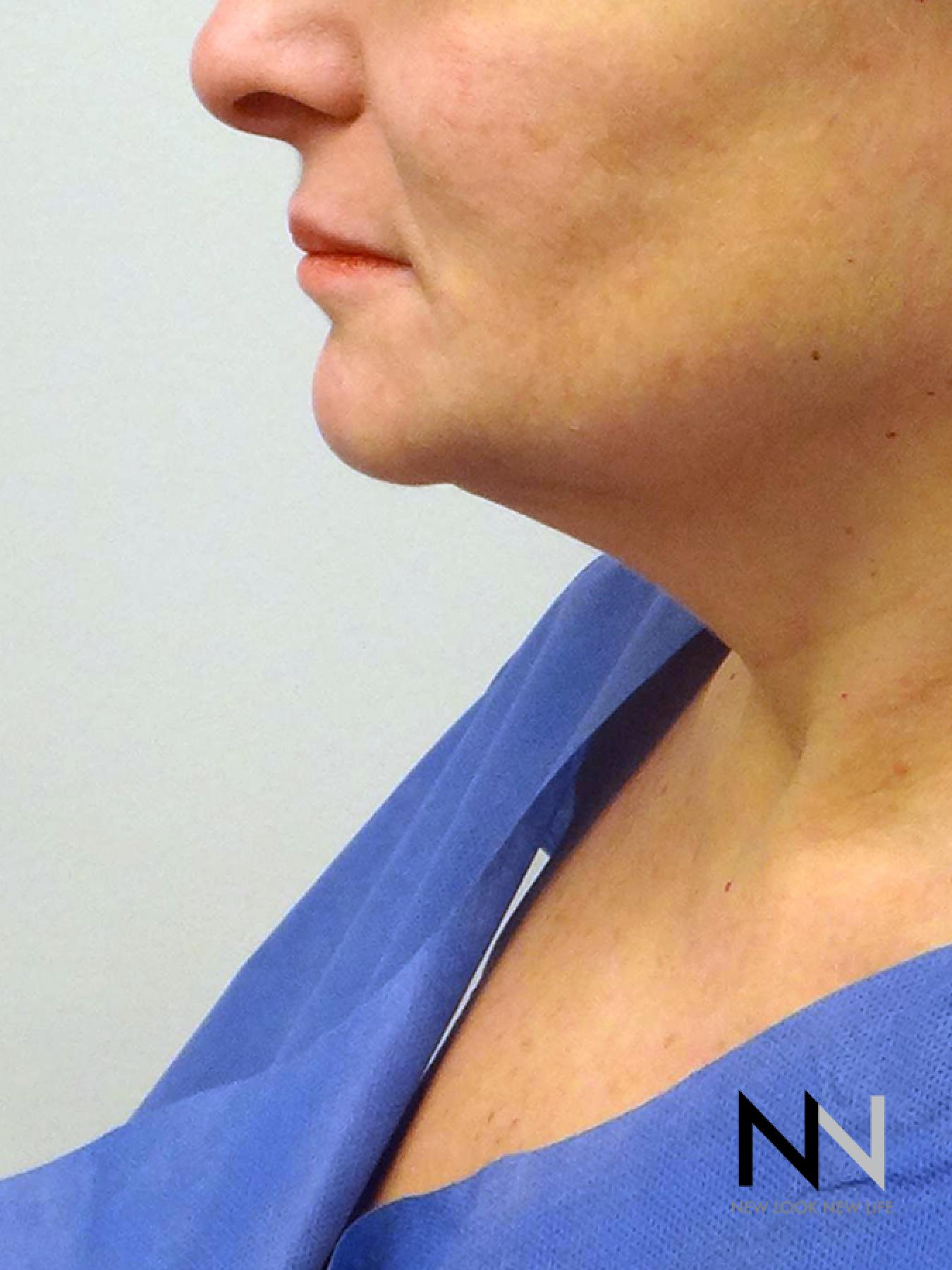 Facelift/Mini Facelift: Patient 8 - Before 1