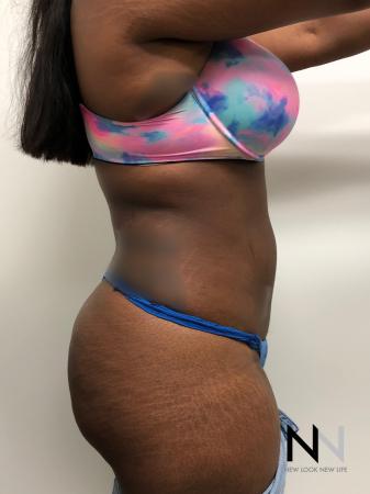 Liposuction: Patient 3 - After Image 3