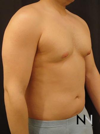 Gynecomastia: Patient 3 - Before Image 3