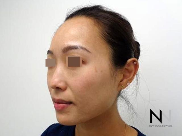 Laser Skin Resurfacing - Face: Patient 5 - Before 