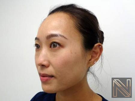 Laser Skin Resurfacing - Face: Patient 5 - Before 