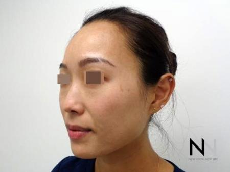 Laser Skin Resurfacing - Face: Patient 5 - Before Image 1