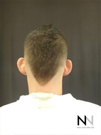 Otoplasty And Earlobe Repair: Patient 2 - Before Image 1