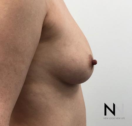 Fat Transfer - Body: Patient 2 - Before Image 3