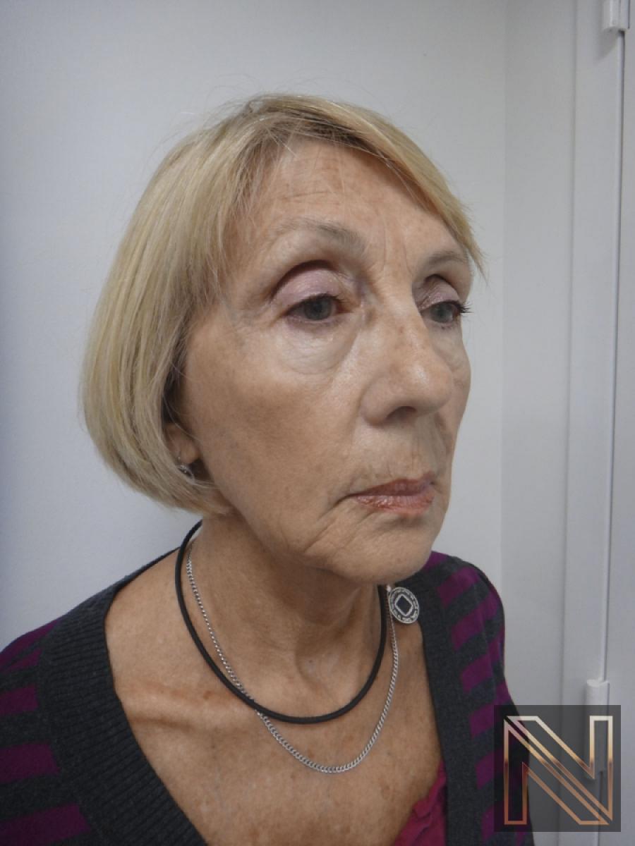 Ultherapy®: Patient 2 - After 2