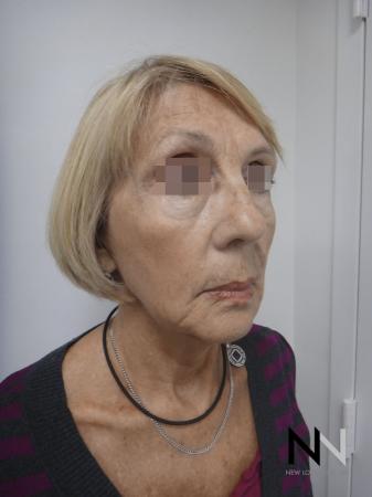 Ultherapy®: Patient 2 - After Image 2