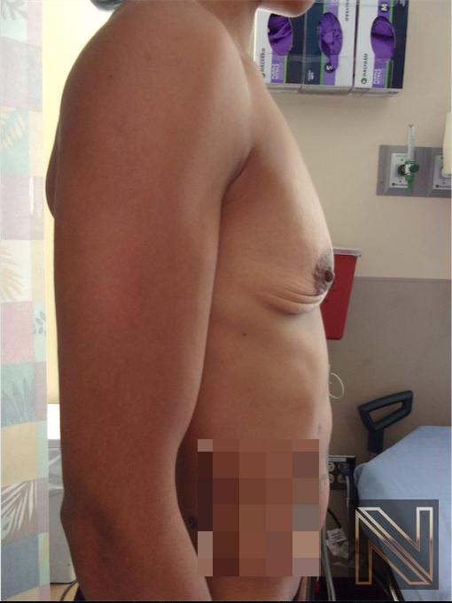 Breast Augmentation: Patient 18 - Before 2