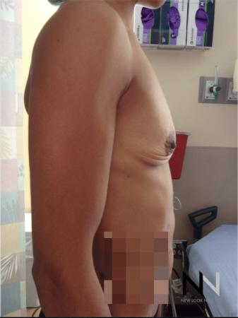 Breast Augmentation: Patient 18 - Before Image 2