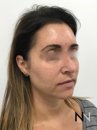 Halo™: Patient 3 - Before Image 4