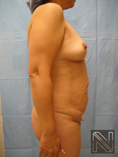Abdominoplasty: Patient 6 - Before and After 3