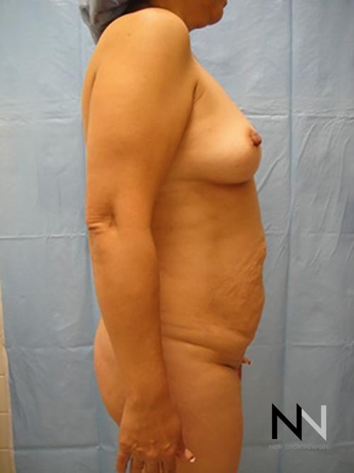 Abdominoplasty: Patient 6 - Before and After 3