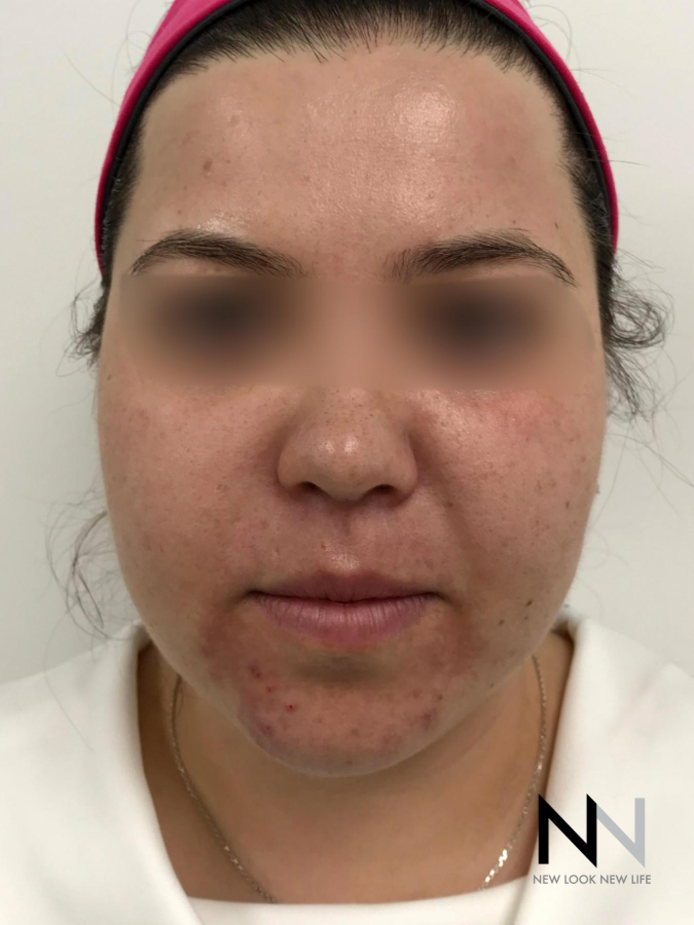 Fractional Resurfacing: Patient 5 - Before 1