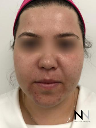 Fractional Resurfacing: Patient 5 - Before Image 1