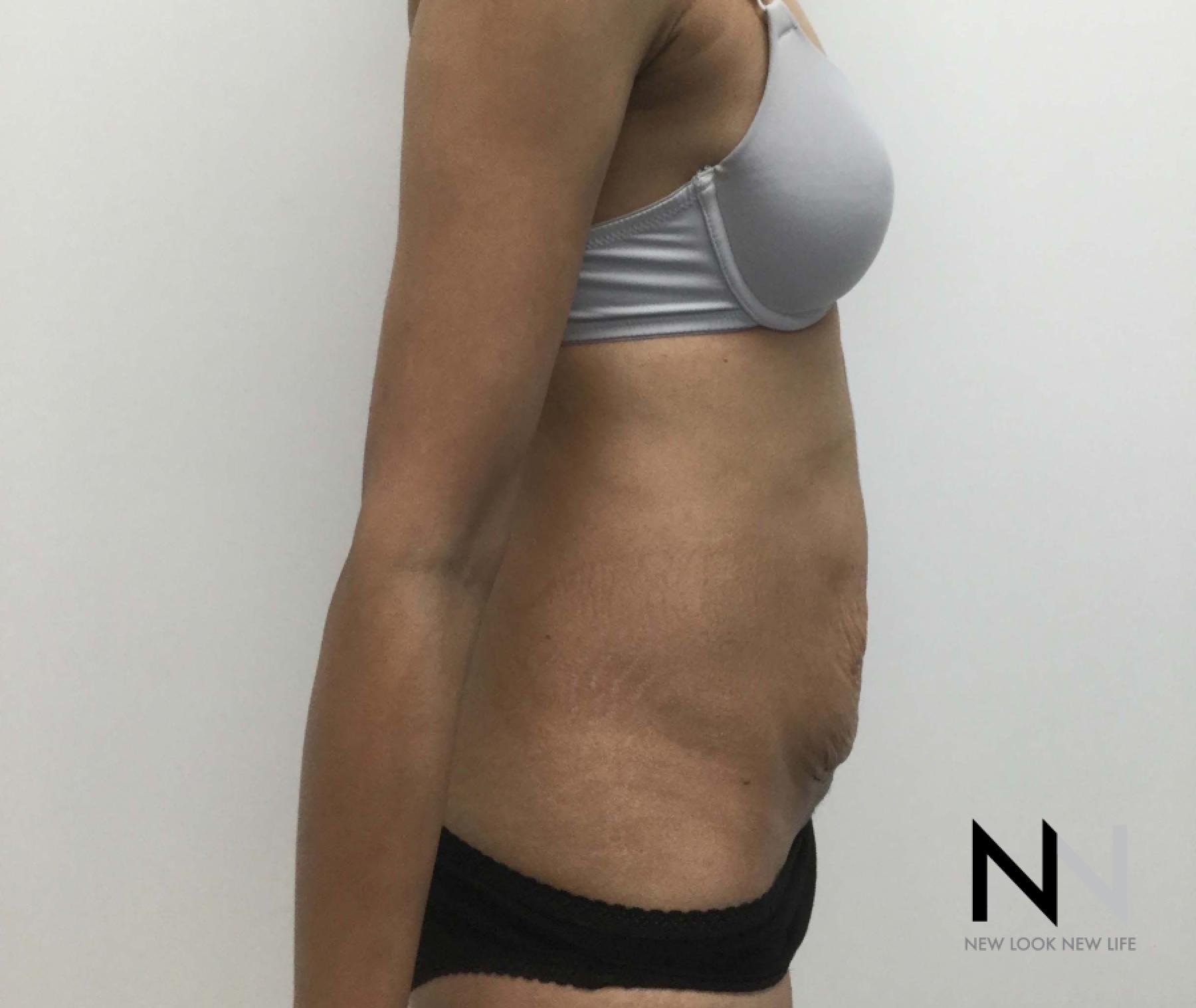 Abdominoplasty: Patient 29 - Before 2