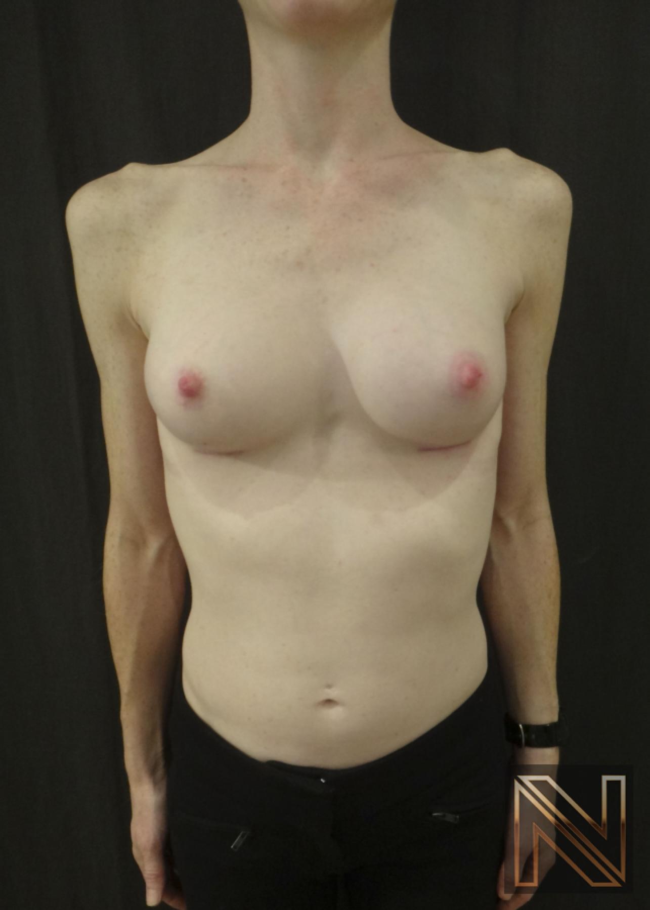 Breast Augmentation: Patient 17 - After 1