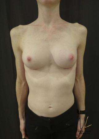 Breast Augmentation: Patient 17 - After Image 1