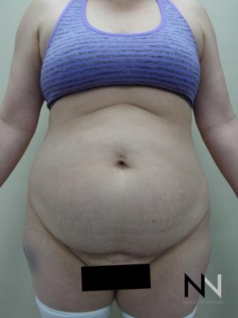 Abdominoplasty: Patient 21 - Before Image 1