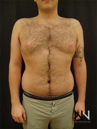 Gynecomastia: Patient 5 - Before Image 1
