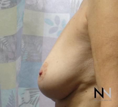 Fat Transfer - Body: Patient 1 - Before Image 3