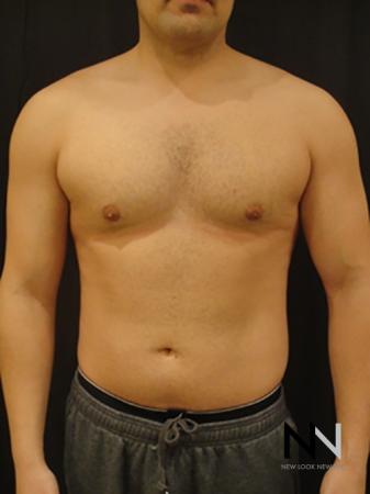 Gynecomastia: Patient 3 - After Image 1